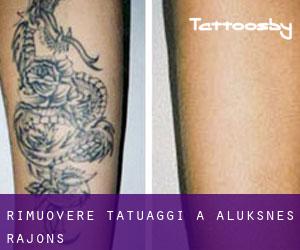 Rimuovere Tatuaggi a Alūksnes Rajons