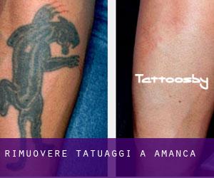 Rimuovere Tatuaggi a Amanca