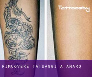 Rimuovere Tatuaggi a Amaro