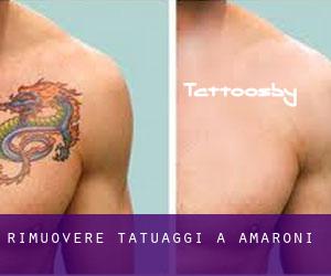 Rimuovere Tatuaggi a Amaroni