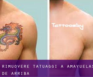 Rimuovere Tatuaggi a Amayuelas de Arriba