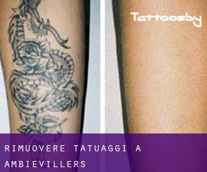 Rimuovere Tatuaggi a Ambiévillers
