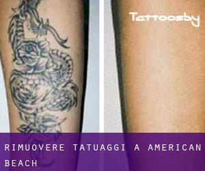 Rimuovere Tatuaggi a American Beach