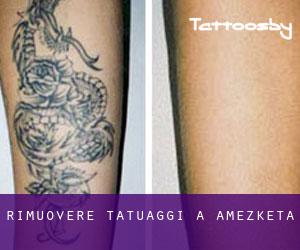 Rimuovere Tatuaggi a Amezketa