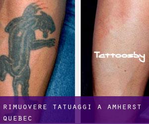 Rimuovere Tatuaggi a Amherst (Quebec)