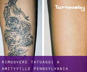 Rimuovere Tatuaggi a Amityville (Pennsylvania)