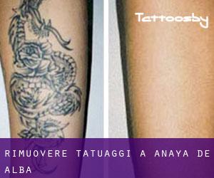 Rimuovere Tatuaggi a Anaya de Alba