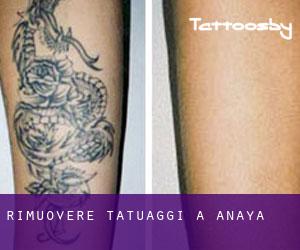 Rimuovere Tatuaggi a Anaya