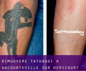 Rimuovere Tatuaggi a Ancourteville-sur-Héricourt