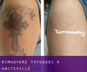 Rimuovere Tatuaggi a Ancteville