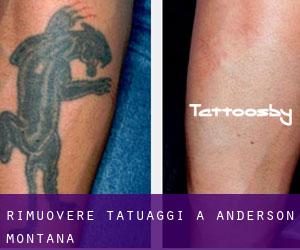 Rimuovere Tatuaggi a Anderson (Montana)