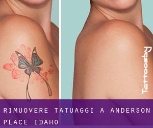 Rimuovere Tatuaggi a Anderson Place (Idaho)