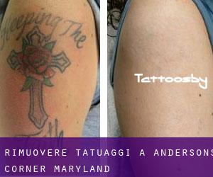 Rimuovere Tatuaggi a Andersons Corner (Maryland)