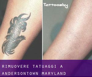 Rimuovere Tatuaggi a Andersontown (Maryland)
