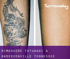 Rimuovere Tatuaggi a Andersonville (Tennessee)
