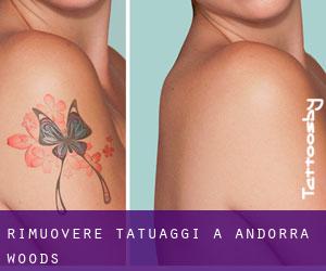 Rimuovere Tatuaggi a Andorra Woods