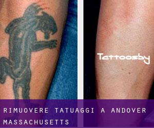 Rimuovere Tatuaggi a Andover (Massachusetts)