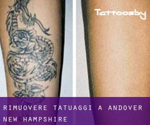 Rimuovere Tatuaggi a Andover (New Hampshire)
