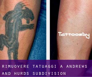 Rimuovere Tatuaggi a Andrews and Hurds Subdivision