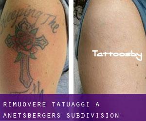 Rimuovere Tatuaggi a Anetsberger's Subdivision