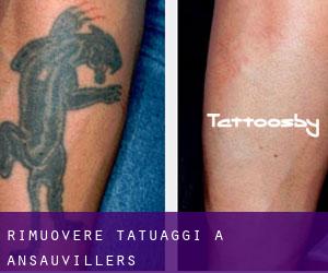 Rimuovere Tatuaggi a Ansauvillers