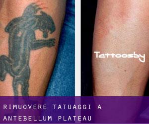Rimuovere Tatuaggi a Antebellum Plateau