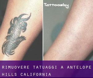 Rimuovere Tatuaggi a Antelope Hills (California)