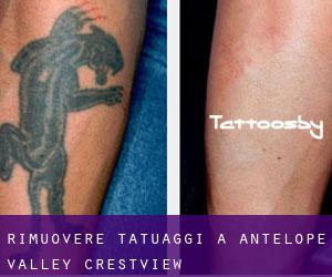 Rimuovere Tatuaggi a Antelope Valley-Crestview