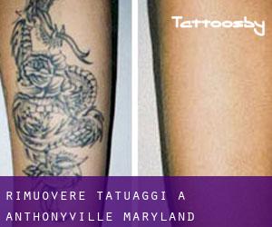 Rimuovere Tatuaggi a Anthonyville (Maryland)
