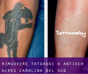Rimuovere Tatuaggi a Antioch Acres (Carolina del Sud)