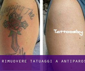 Rimuovere Tatuaggi a Antíparos