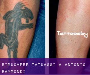 Rimuovere Tatuaggi a Antonio Raymondi