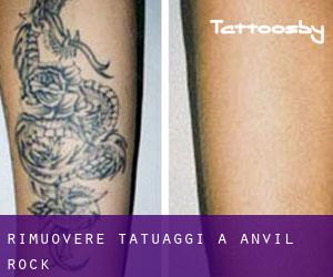 Rimuovere Tatuaggi a Anvil Rock