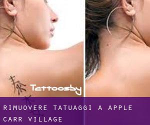 Rimuovere Tatuaggi a Apple Carr Village