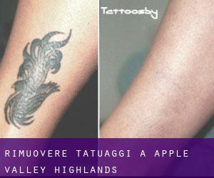 Rimuovere Tatuaggi a Apple Valley Highlands