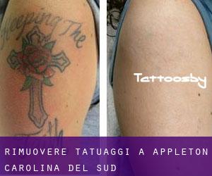 Rimuovere Tatuaggi a Appleton (Carolina del Sud)