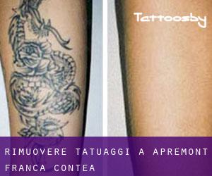 Rimuovere Tatuaggi a Apremont (Franca Contea)