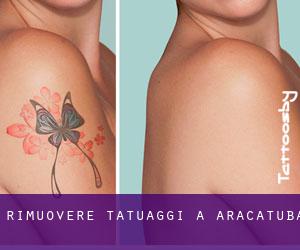 Rimuovere Tatuaggi a Araçatuba