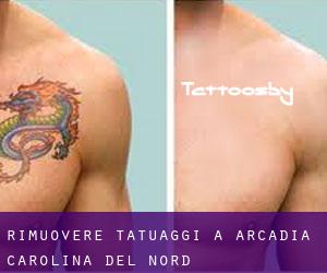 Rimuovere Tatuaggi a Arcadia (Carolina del Nord)