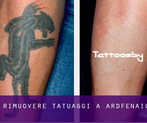 Rimuovere Tatuaggi a Ardfenaig