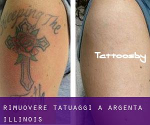 Rimuovere Tatuaggi a Argenta (Illinois)