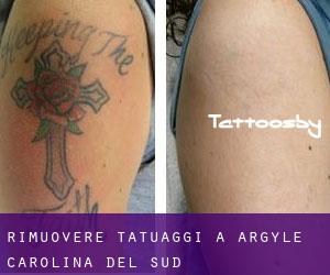 Rimuovere Tatuaggi a Argyle (Carolina del Sud)