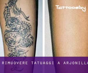 Rimuovere Tatuaggi a Arjonilla