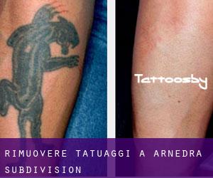 Rimuovere Tatuaggi a Arnedra Subdivision