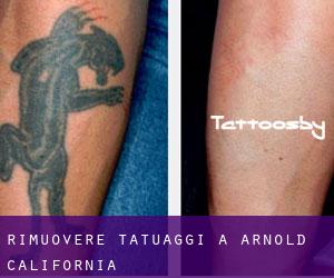 Rimuovere Tatuaggi a Arnold (California)