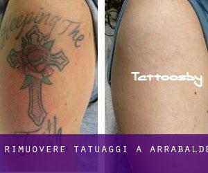Rimuovere Tatuaggi a Arrabalde