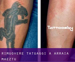 Rimuovere Tatuaggi a Arraia-Maeztu