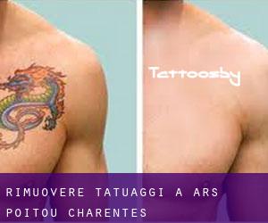 Rimuovere Tatuaggi a Ars (Poitou-Charentes)