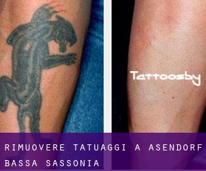 Rimuovere Tatuaggi a Asendorf (Bassa Sassonia)