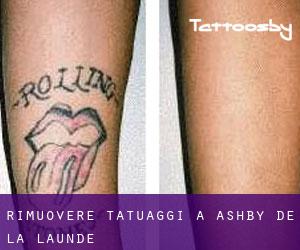 Rimuovere Tatuaggi a Ashby de la Launde